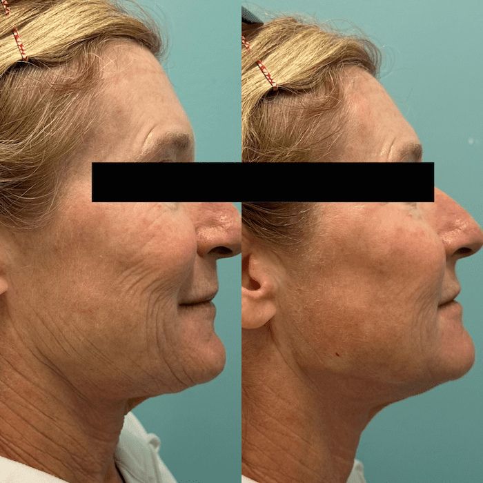 See the Botox Difference (3)