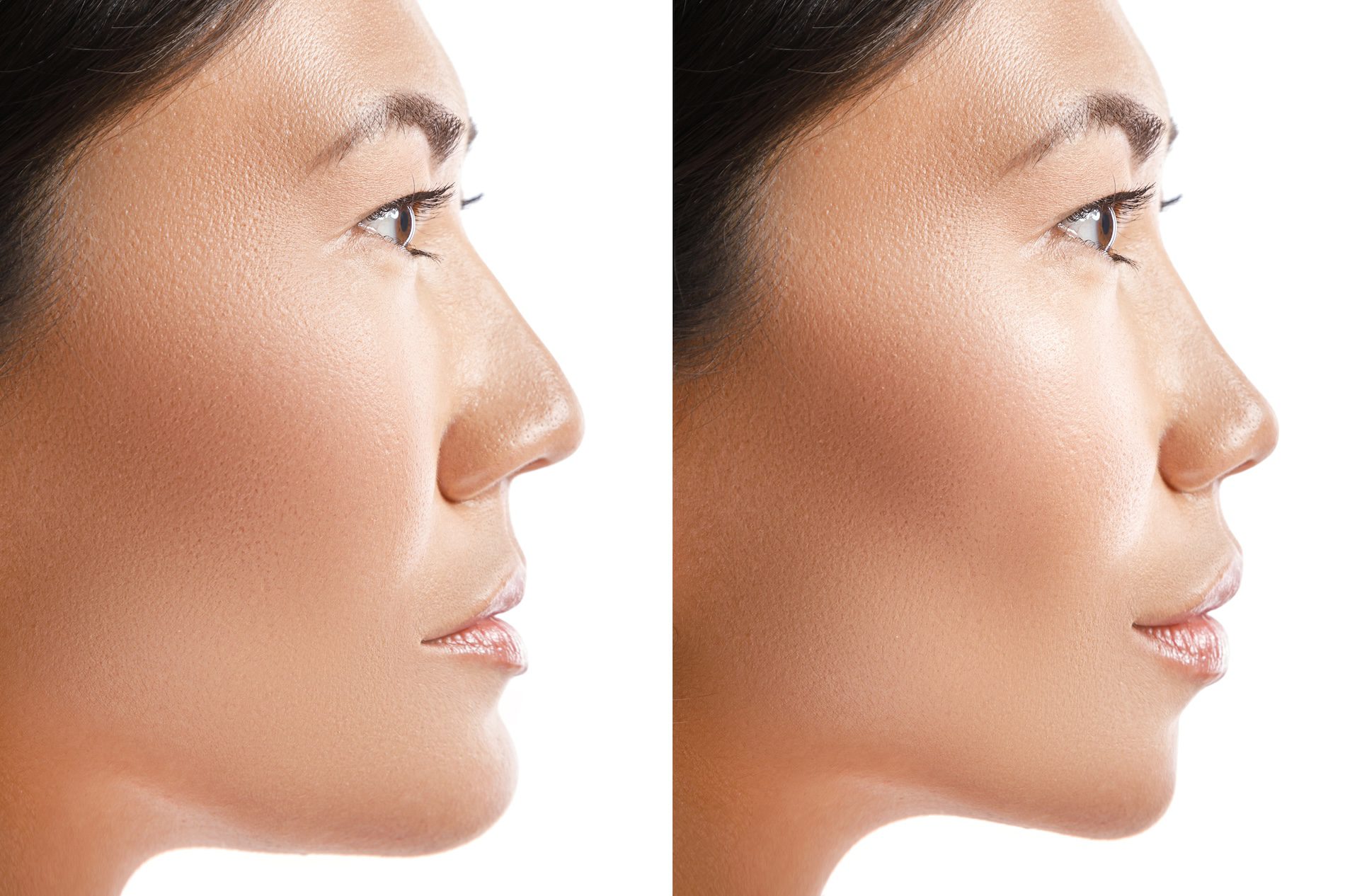 Transformation of Asian woman. Result of plastic surgery. Concept of different modifications with a face.