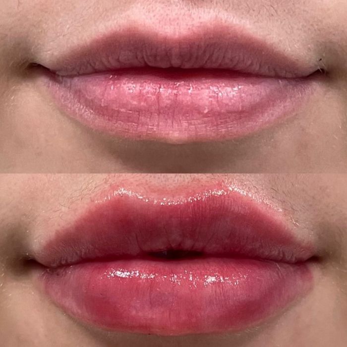 _See the Dermal Filler Difference