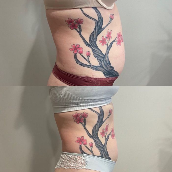 _See the Emsculpt NEO Difference