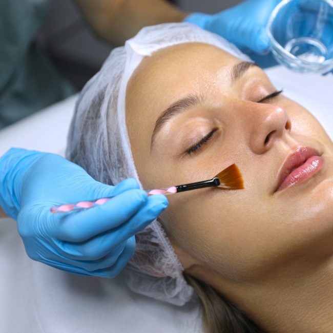 Chemical Peels and Microneedling Near Frederick, Maryland