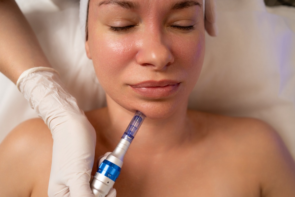 Microneedling Treatment Options Near Frederick Maryland