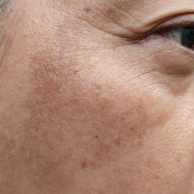 Dark Spot Treatment in Frederick and Near Mount Airy MD: BBL and Laser Options