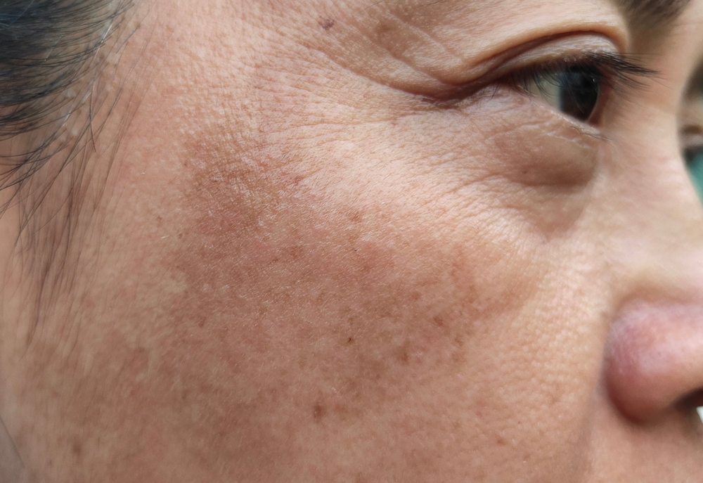 Dark Spot Treatment in Frederick and Near Mount Airy MD: BBL and Laser Options