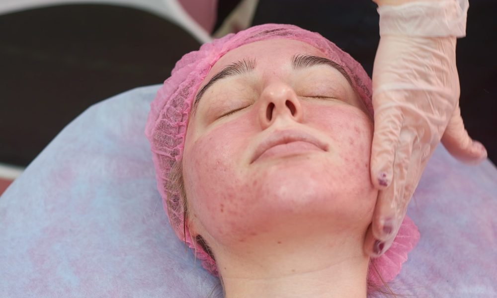 Hand of cosmetician, problematic skin. Hand of cosmetician, problematic skin. Female face with acne.
