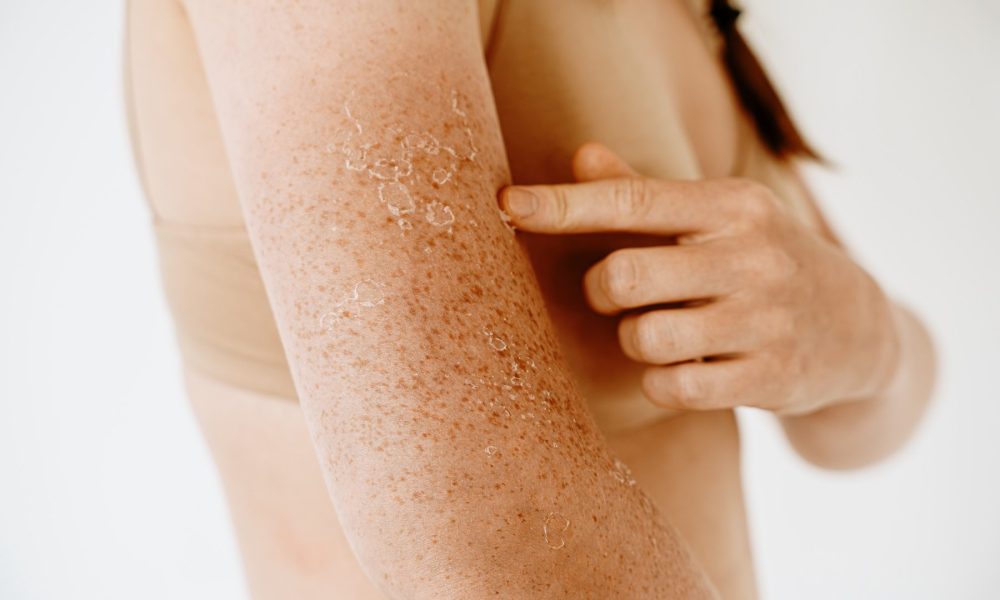 Peeling skin after sunburn, dermatology problems at woman hand and shoulder, flaking skin and skincare concept, sensitive skin. Peeling skin after sunburn, dermatology problems at woman hand and shoulder, flaking skin and skincare concept, sensitive skin