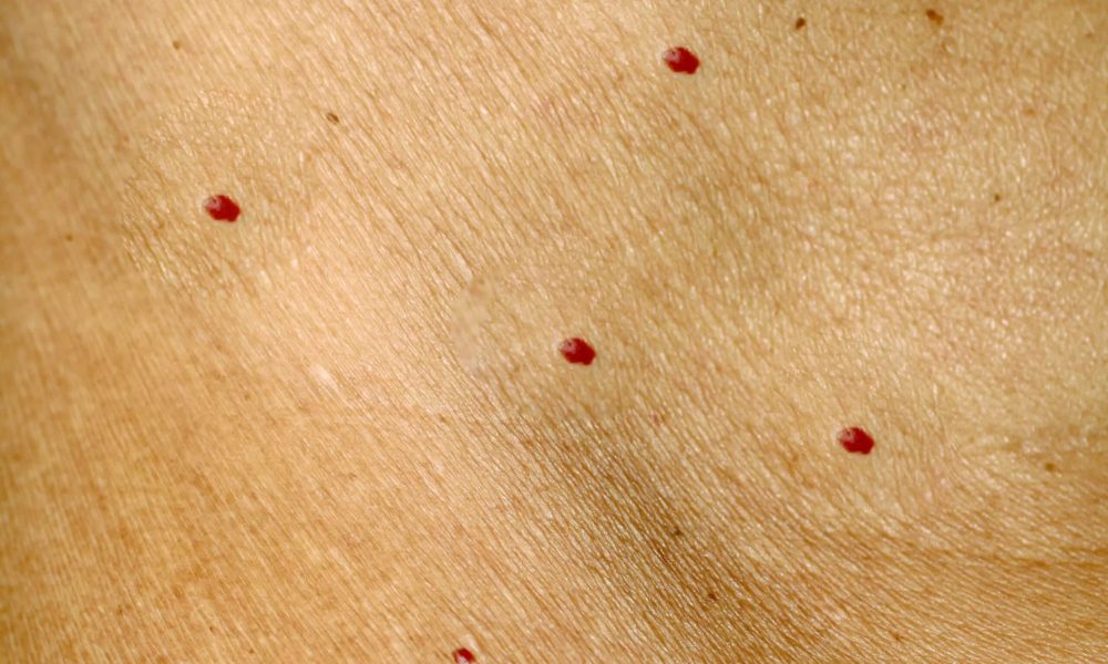 cherry angiomas cherry angiomas